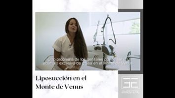 Liposucción en el monte de venus - Eiviestetic