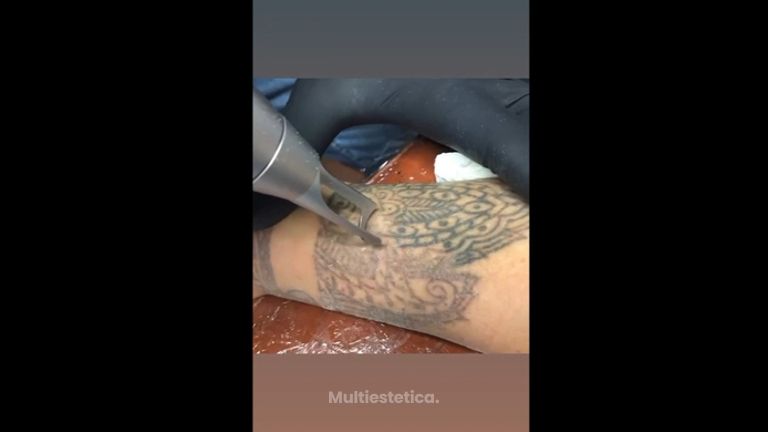 Eliminación de tatuaje - Cenydiet