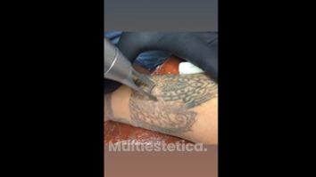 Eliminación de tatuaje - Cenydiet