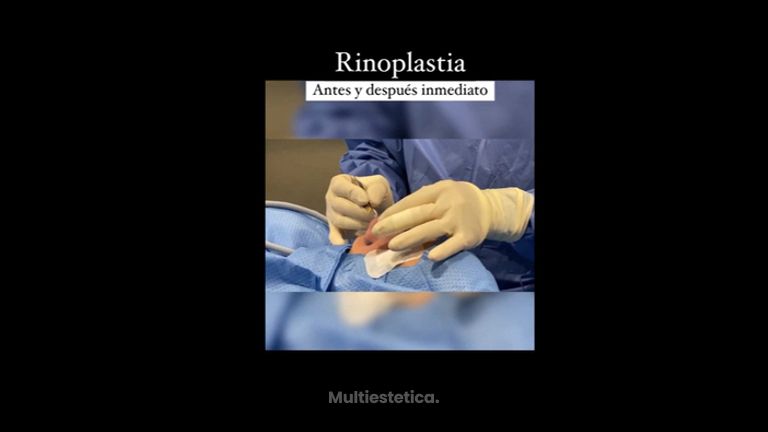 Rinoplastia - Clínica Dr. Jiménez