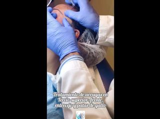 Rellenos faciales - Centro Médico Primo De Rivera