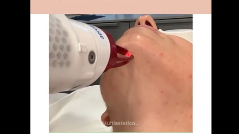 Aerolase Neo Elite Aerolase mejora las lesiones de acné, disminuye la inflamación, reduce el sebo y destruye la colonización de las bacterias presentes en el acné.