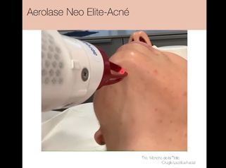 Aerolase Neo Elite Aerolase mejora las lesiones de acné, disminuye la inflamación, reduce el sebo y destruye la colonización de las bacterias presentes en el acné.