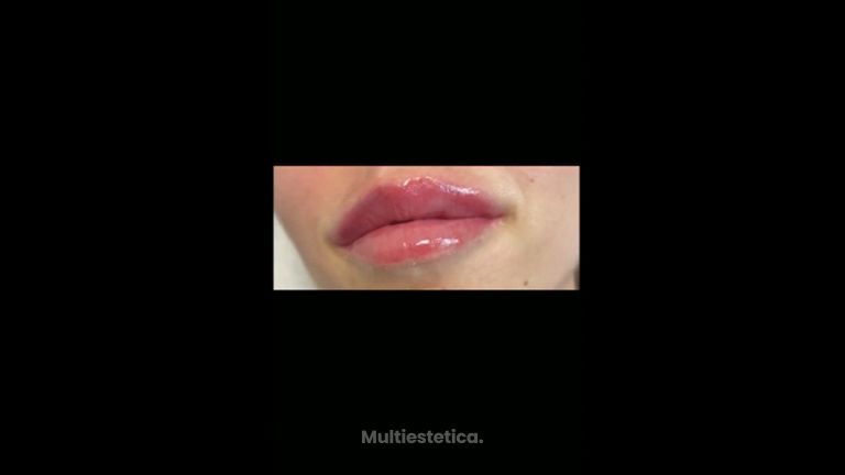 Aumento de labios - Dr. Pérez Villar