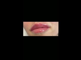 Aumento de labios - Dr. Pérez Villar