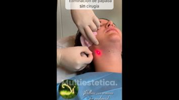 Liposucción de papada - Clínicas Dra. Matas