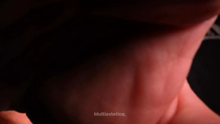 Tecnología 3D y máxima precisión en rinoplastia ultrasónica