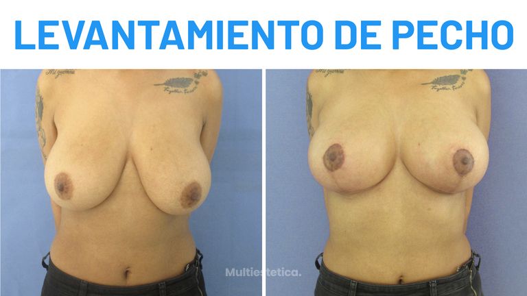 Mastopexia - Leidy Yurani