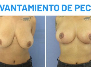 Mastopexia - Leidy Yurani