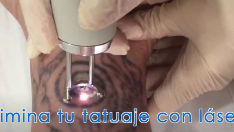 Eliminación de tatuajes - Clínica Openderma