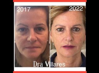 Rellenos faciales - Doctora Villares