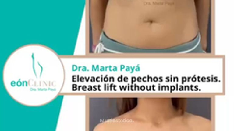 Elevación de pecho