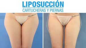 Resultados de la liposucción Resultados de la liposucción