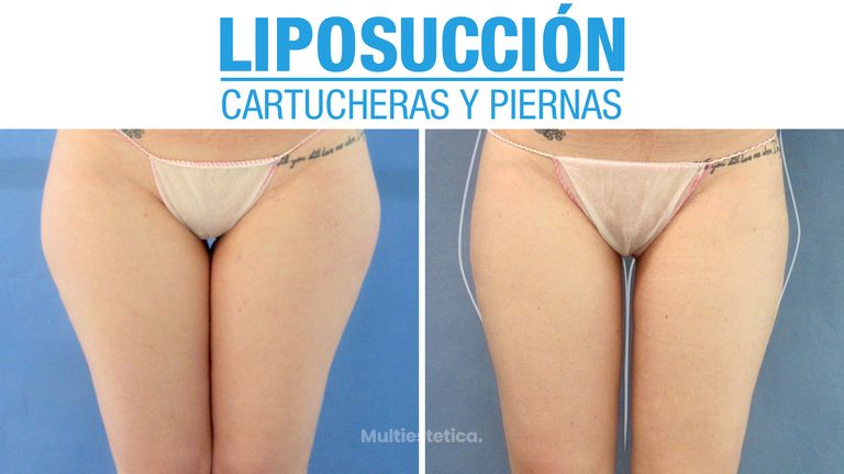 Resultados de Liposucción de Piernas