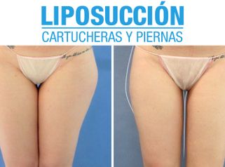 Resultados de Liposucción de Piernas