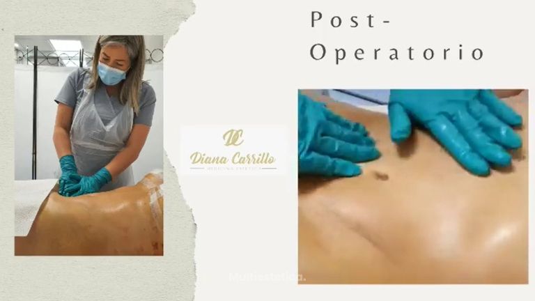 Tratamiento post-operatorio - Diana Carrillo