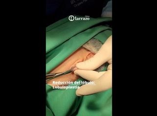 Lobuloplastia - Clínica Tarrazo