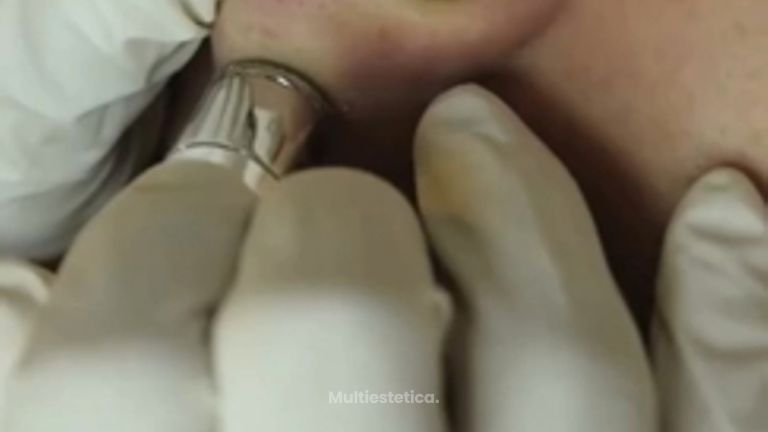 MICRODERMOABRASIÓN CON PUNTA DE DIAMANTE