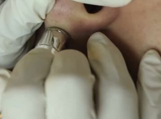 MICRODERMOABRASIÓN CON PUNTA DE DIAMANTE
