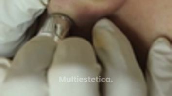 MICRODERMOABRASIÓN CON PUNTA DE DIAMANTE