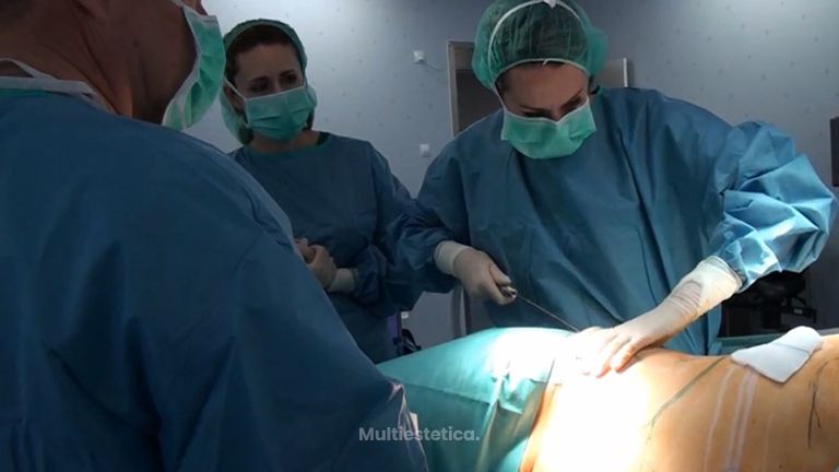 Liposuctor Asistido por Agua Body Jet Agualipo Dra Martínez Padilla