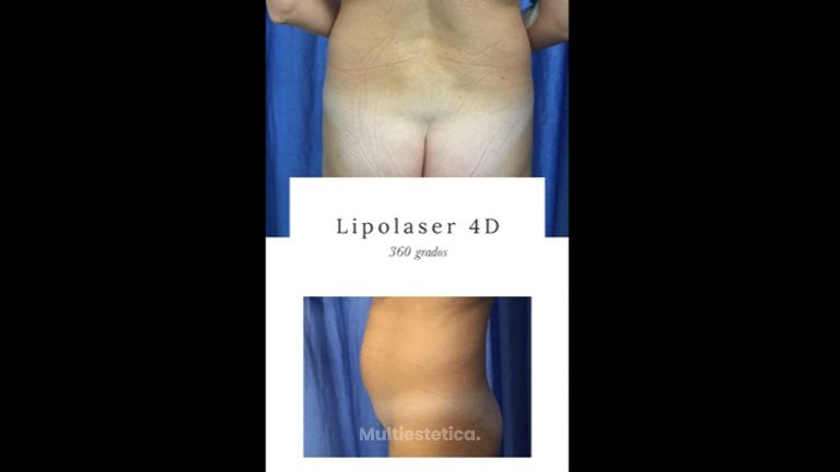 Lipoláser 360º - Dr. José María Serra Mestre