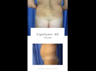 Lipoláser 360º - Dr. José María Serra Mestre