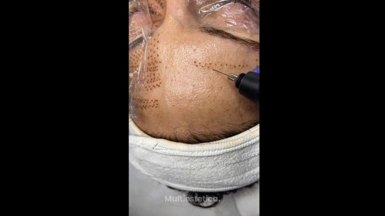 Blefaroplastia son cirugía y eliminación de arrugas - Balneo Estetic Pasbel