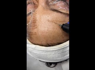 Blefaroplastia son cirugía y eliminación de arrugas - Balneo Estetic Pasbel