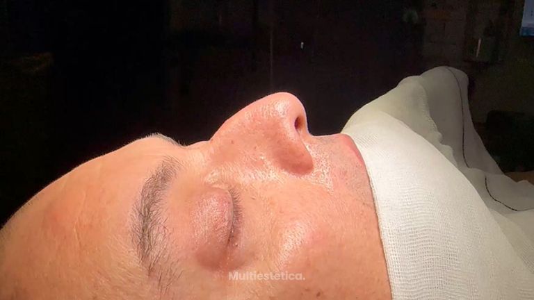 Rinoplastia - Dr. Amaro Camacho