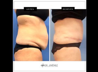 Abdominoplastia - Dr. Jiménez Ortiz
