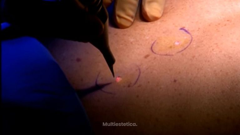 ¿Cómo eliminar las verrugas?