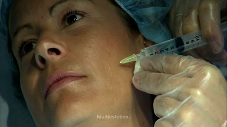 Estimular la producción de colágeno con mesoterapia facial
