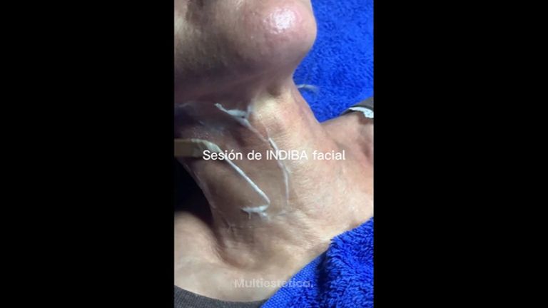INDIBA facial - Clínica Vega