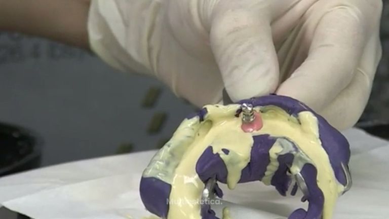 Así es el proceso analógico de los implantes dentales 