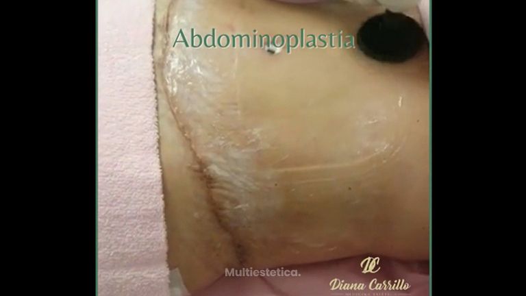 Abdominoplastia - Diana Carrillo