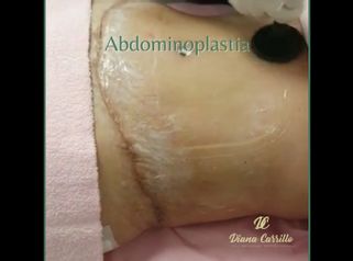 Abdominoplastia - Diana Carrillo