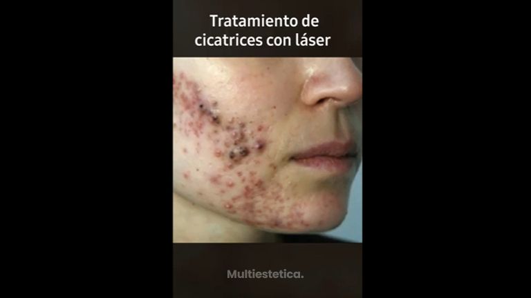 Tratamiento antiacné - Doctora Barba Martínez