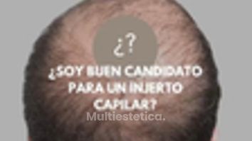 👨_⚕️ ¿Soy buen candidato para un injerto capilar?