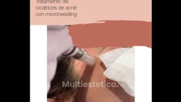 Microneedling + PRP (Plasma Rico en Plaquetas) es un procedimiento de rejuvenecimiento cutáneo mínimamente invasivo.