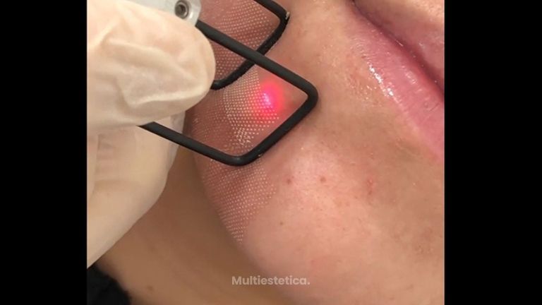 Laser CO2 - Clínica Dr. Carvajal