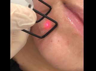 Laser CO2 - Clínica Dr. Carvajal