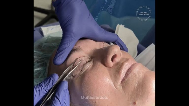 Blefaroplastia - Dr. Joshi Otero