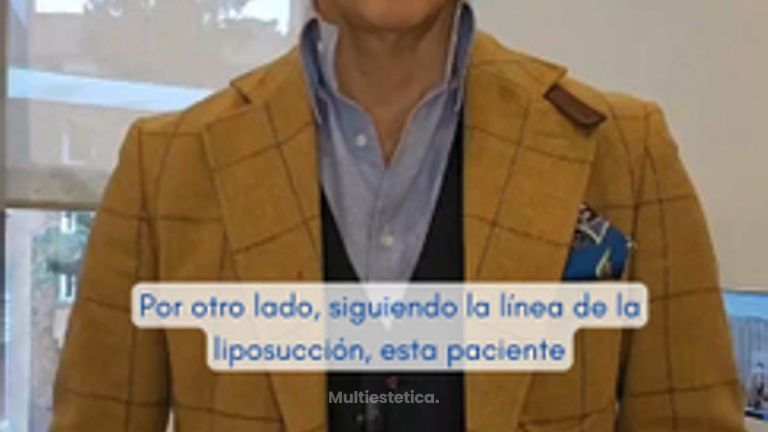 Liposucción abdominal ¿Se verán las cicatrices?