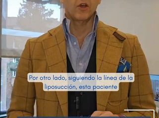 Liposucción abdominal ¿Se verán las cicatrices?