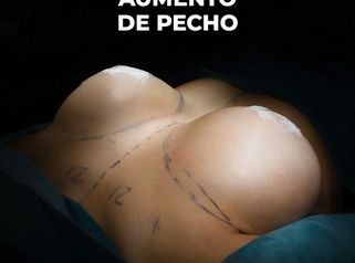Aumento de pecho + corrección de pezones - Clínica Opción Médica