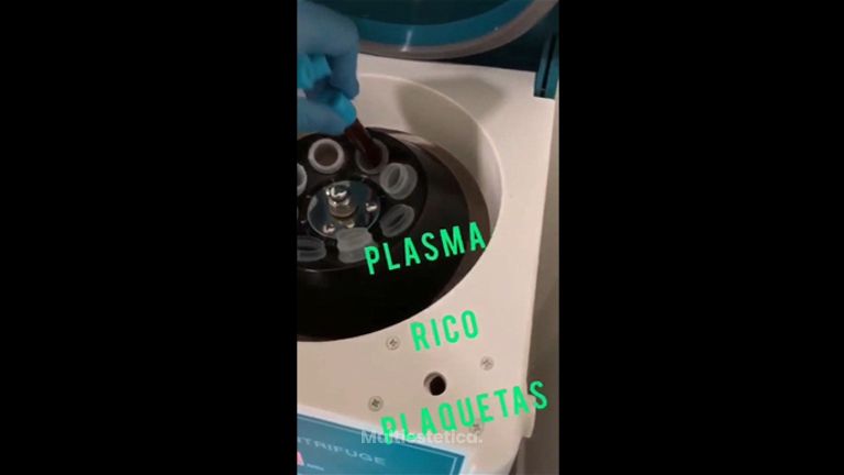 PRP, Plasma Rico en Plaquetas - Monalisa Clínicas