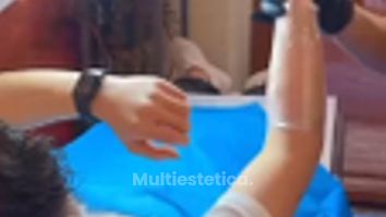 TRATAMIENTO DE CICATRICES CON LASER CO2 FRACCIONADO