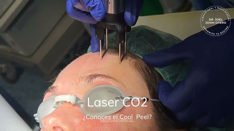 Láser CO2 fraccionado para el rejuvenecimiento facial - Dr. Joshi Otero