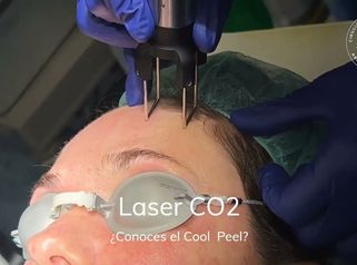 Láser CO2 fraccionado para el rejuvenecimiento facial - Dr. Joshi Otero